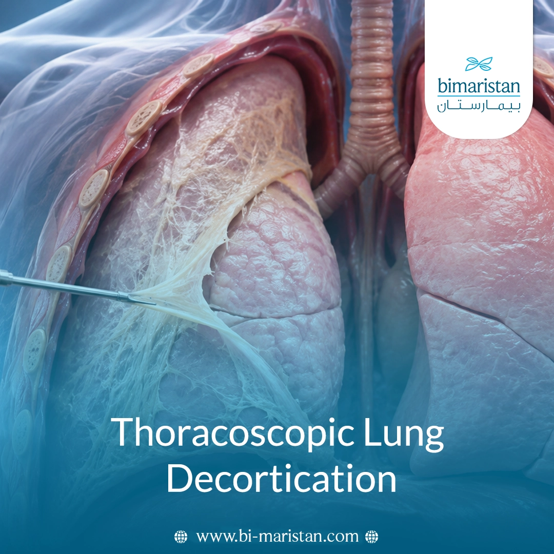 Thoracoscopic Lung Decortication Copy