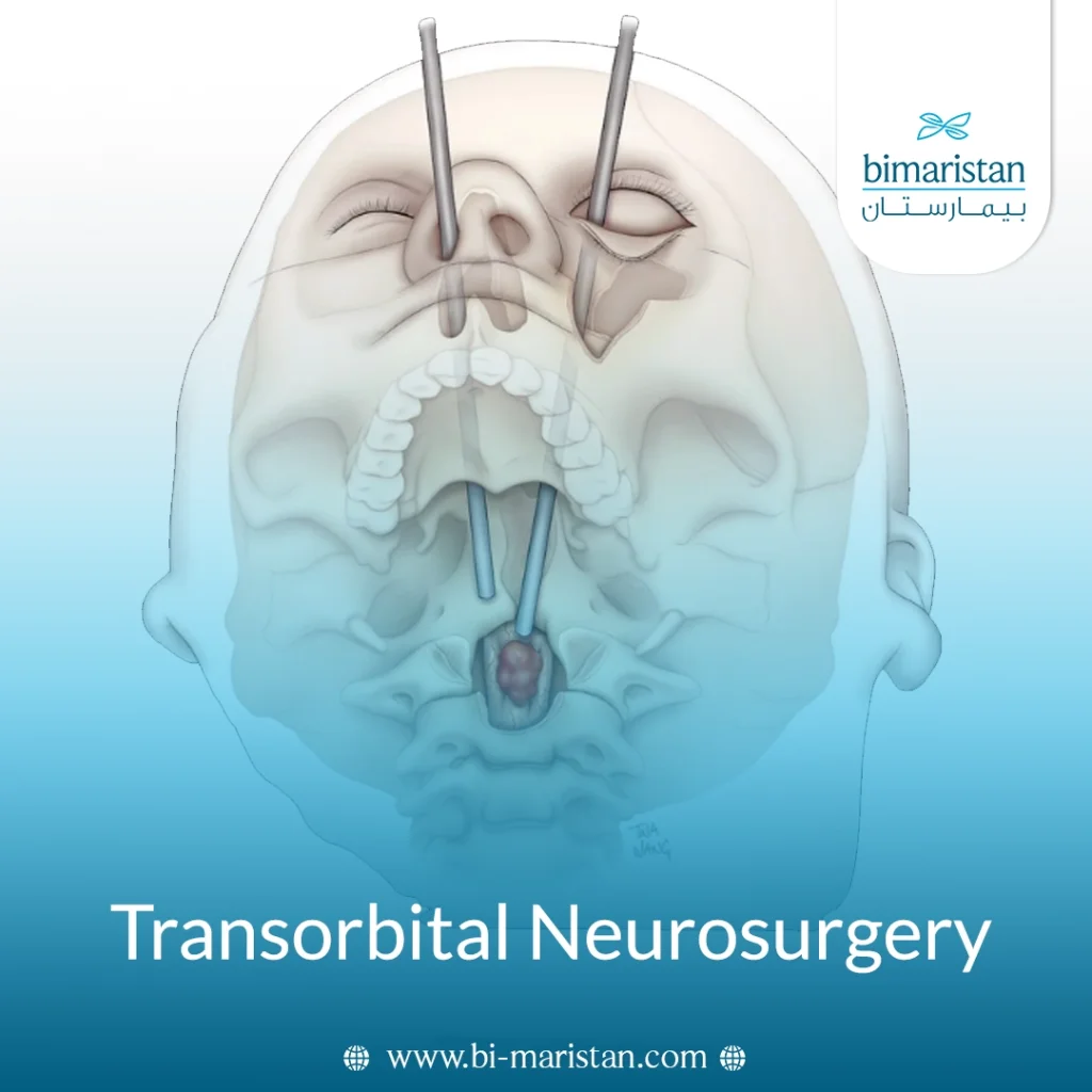 Transorbital Neurosurgery