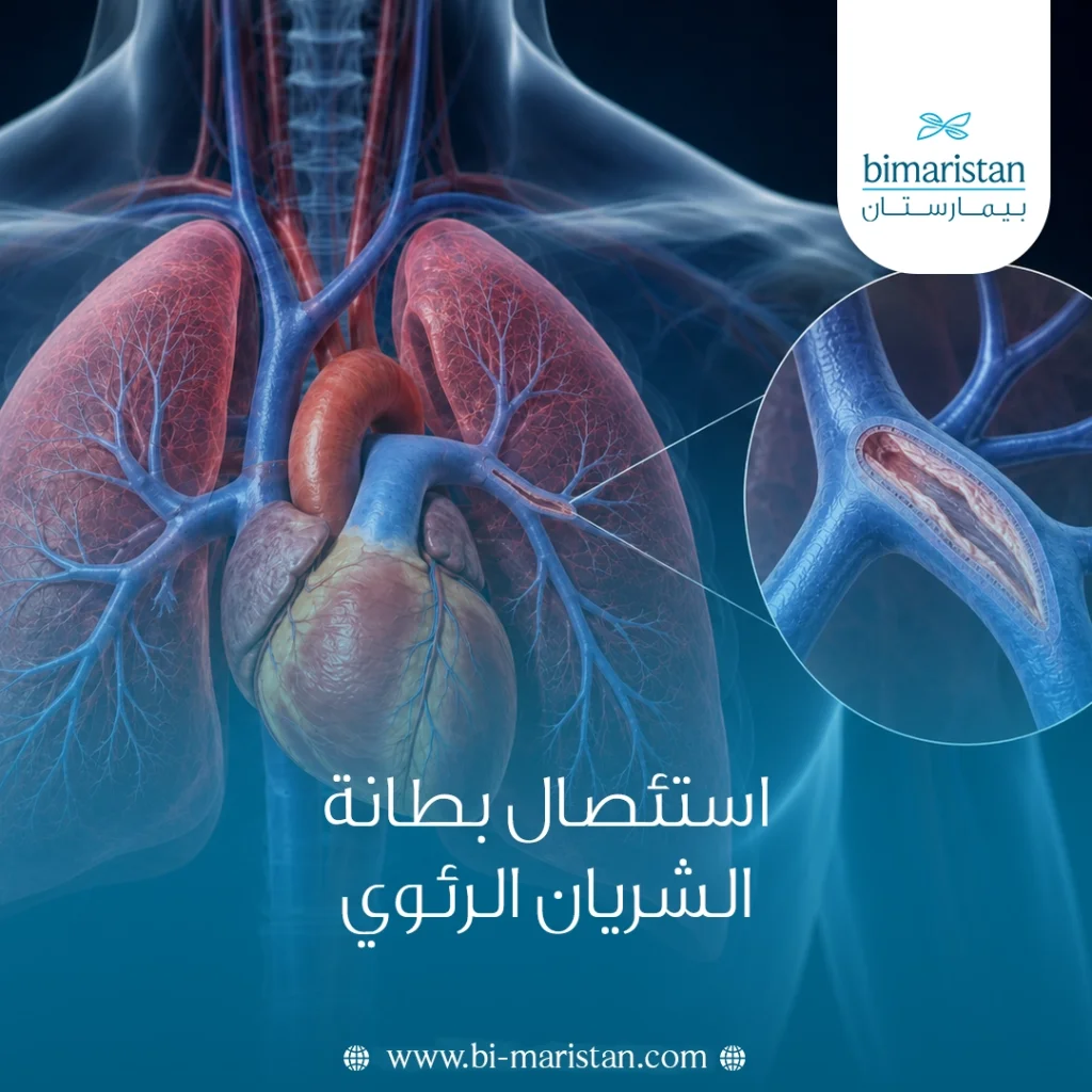 استئصال بطانة الشريان الرئوي