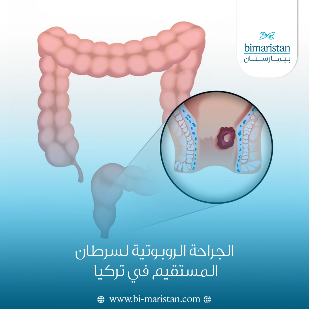 الجراحة الروبوتية لسرطان المستقيم في تركيا