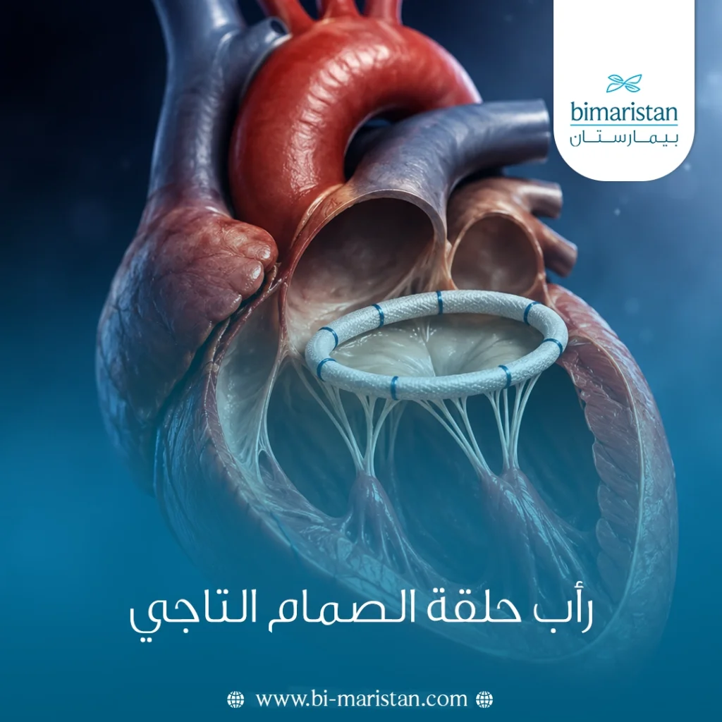 رأب حلقة الصمام التاجي