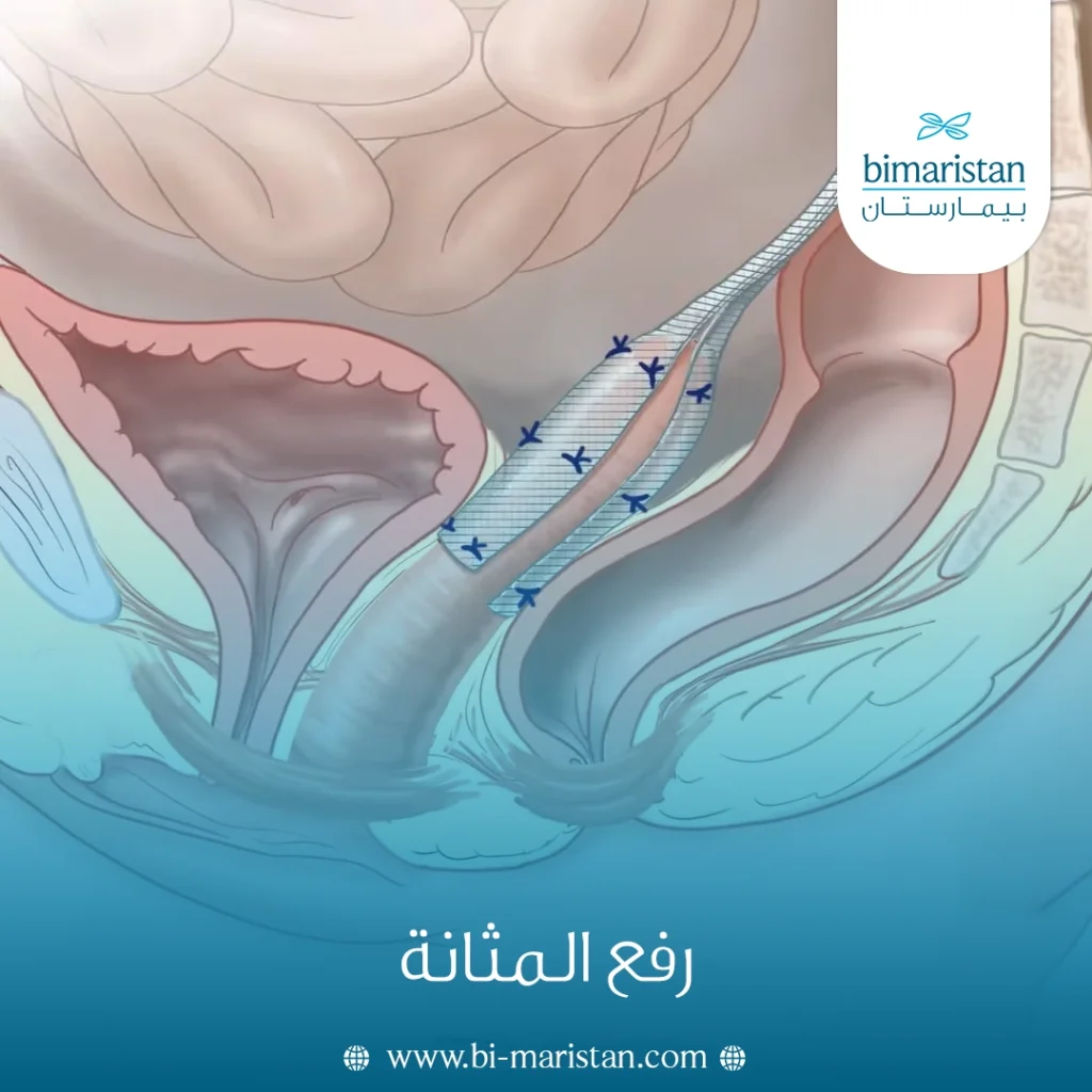رفع المثانة