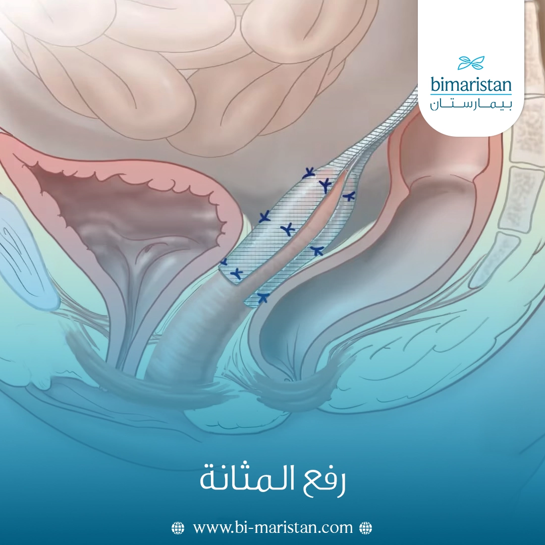 رفع المثانة