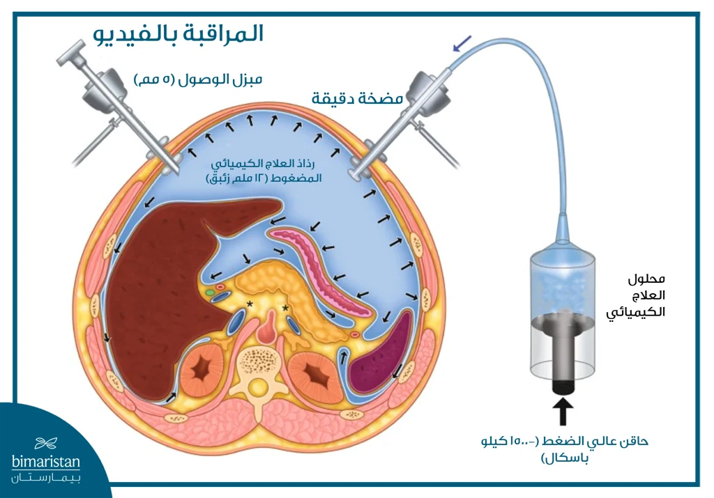 توضّح الصورة العلاج الكيميائي بالرذاذ المضغوط داخل الصفاق (Pipac).