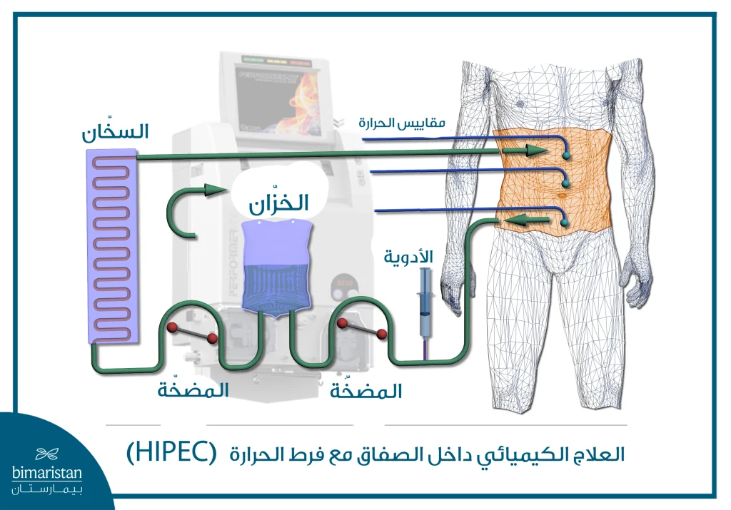 توضّح الصورة تقنية العلاج الكيميائي الساخن داخل الصفاق (Hipec).