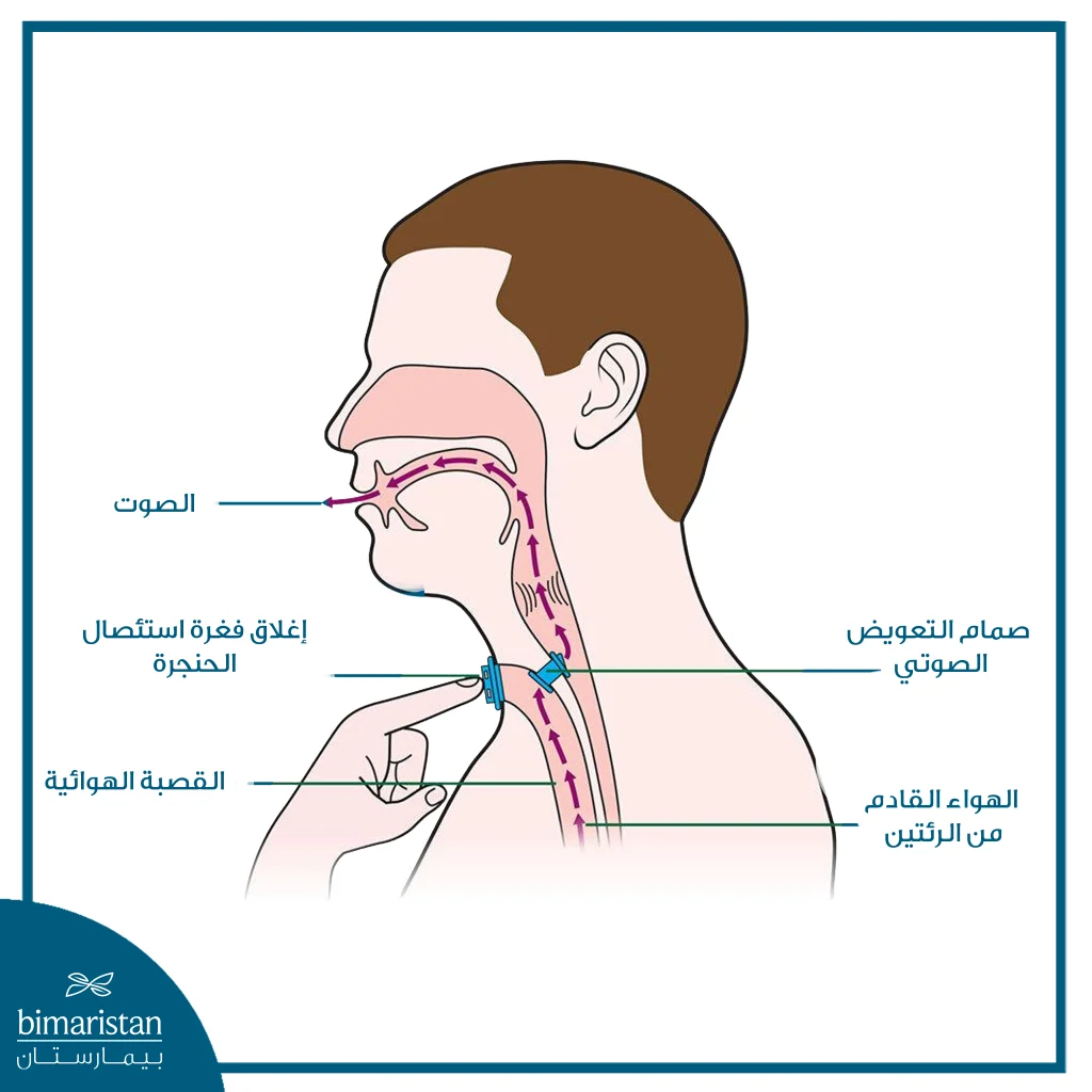 رسم توضيحي يبيّن استعادة الصوت بعد استئصال الحنجرة باستخدام النطق الرغامي المريئي والصمام الصوتي.
