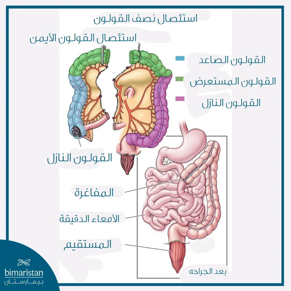 رسم طبي يوضح استئصال القولون الأيمن المصاب بورم سرطاني وإعادة توصيل الأمعاء بعد الجراحة.