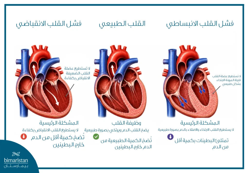 رسم طبي يقارن بين القلب الطبيعي وفشل القلب الانقباضي وفشل القلب الانبساطي، مع توضيح الاختلاف في انقباض عضلة القلب وامتلاء البطين الأيسر أثناء ضخ الدم