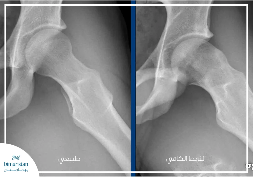 صورة بالأشعة السينية توضح متلازمة الانحشار الفخذي الحُقّي بالنمط الكامي