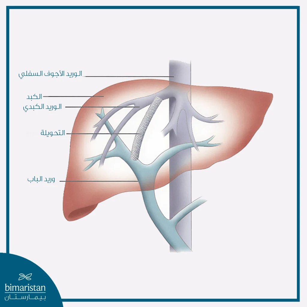 صورة توضح التحويلة البابية الجهازية داخل الكبد عبر الوداجي (Tips)