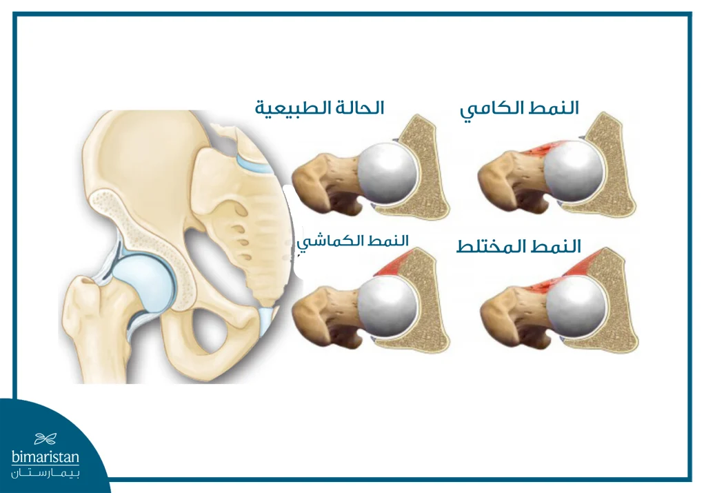 صورة توضح أنواع متلازمة الانحشار الفخذي الحُقّي