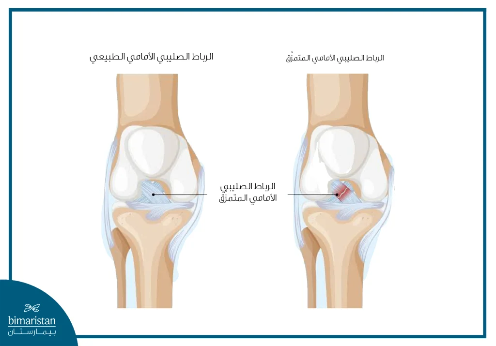 صورة توضح حالة تمزق الرباط الصليبي الأمامي