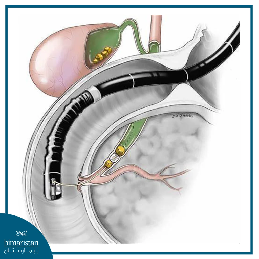 Bile Duct Cancer: Symptoms, Diagnosis, And The Latest Treatment Methods 3 An Image Illustrating Ercp