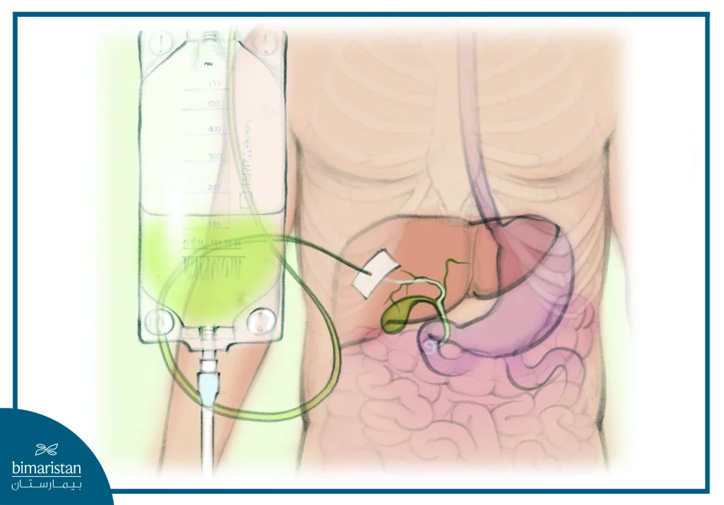 Bile Duct Cancer: Symptoms, Diagnosis, And The Latest Treatment Methods 4 An Image Illustrating Percutaneous Biliary Drainage (Pbd)