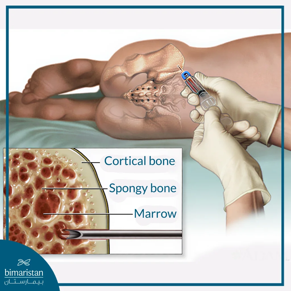 An Image Illustrating A Bone Marrow Biopsy Procedure From The Pelvic Bone (Ilium).