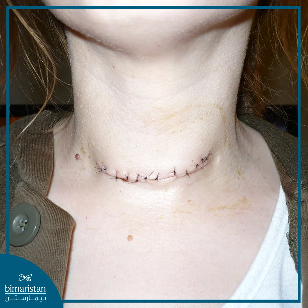 An Image Showing The Scar After Parathyroidectomy.