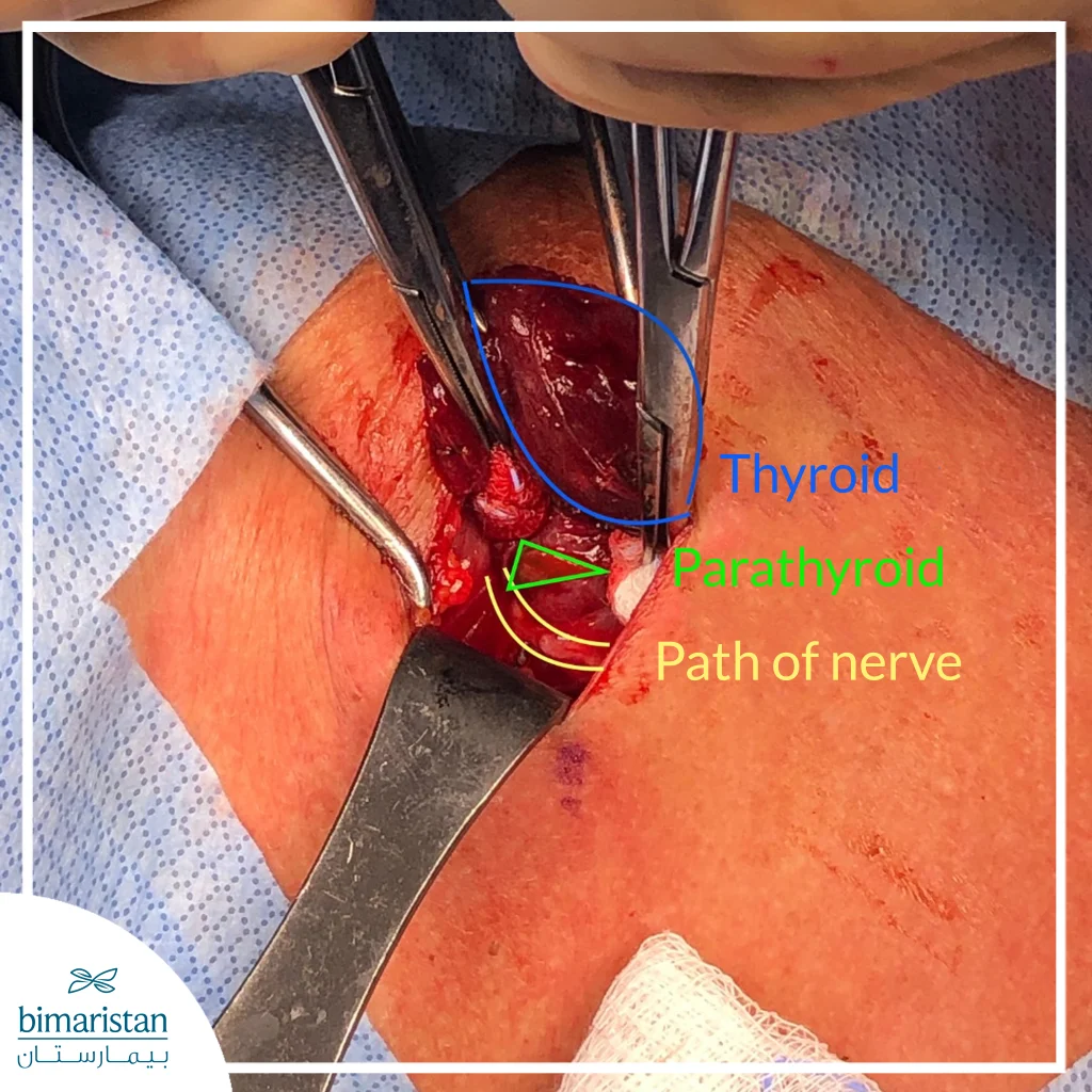 An Intraoperative Image During Parathyroidectomy Showing The Parathyroid Gland And The Course Of The Recurrent Laryngeal Nerve