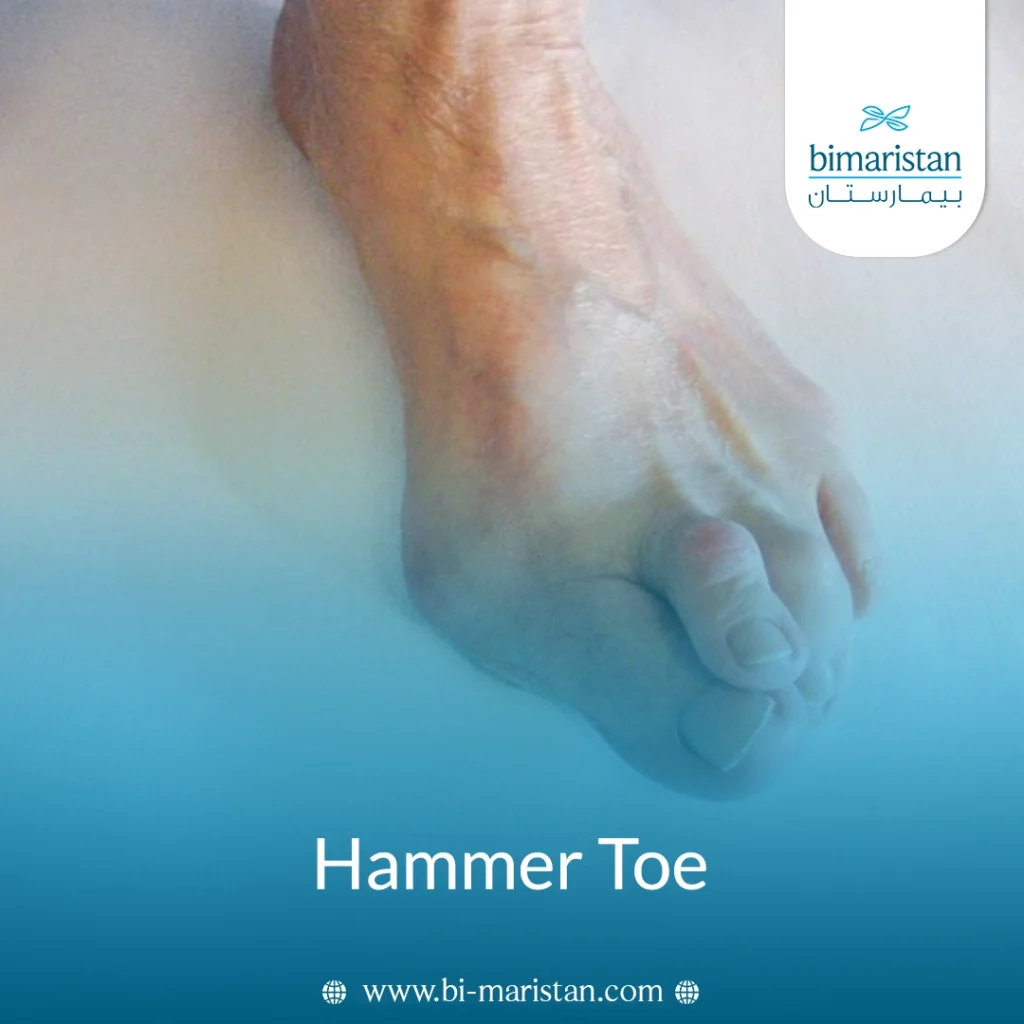 Hammer Toe