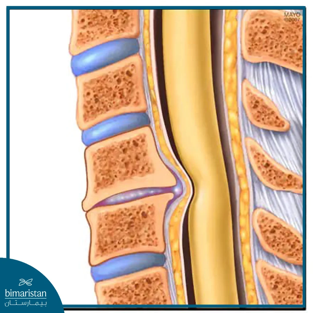 How A Herniated Disc Compresses The Spinal Cord