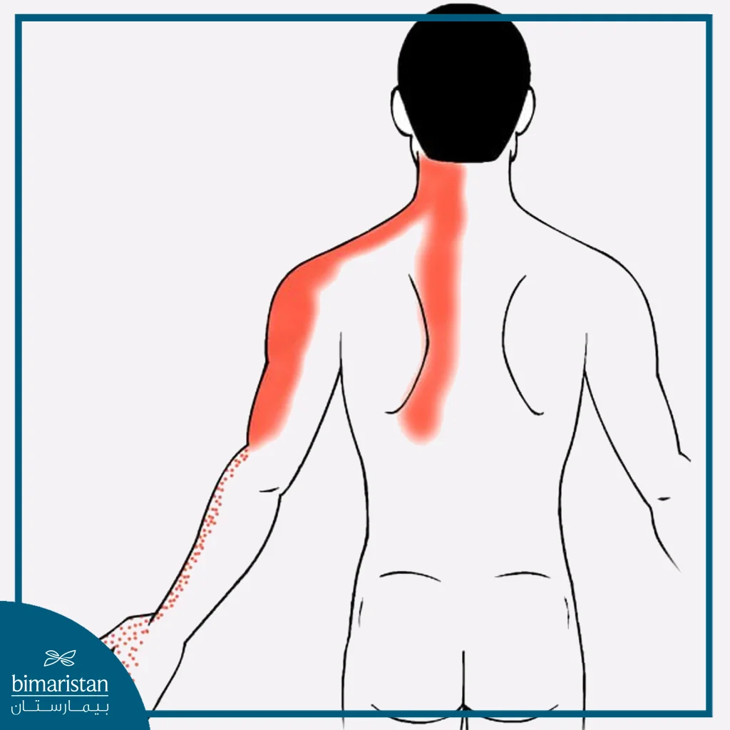 Radiation Of Cervical Herniated Disc Symptoms And Its Effect On Hand Numbness