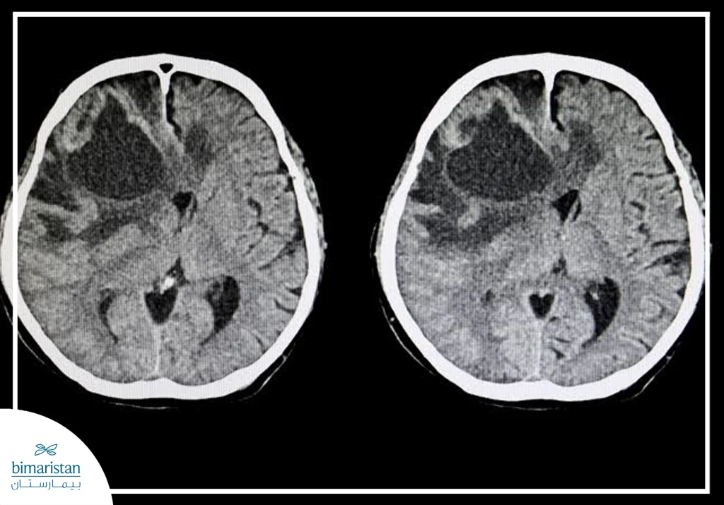 Early Symptoms Of Brain Tumors: Warning Signs You Should Never Ignore 3 X-Ray Image Showing A Brain Tumor