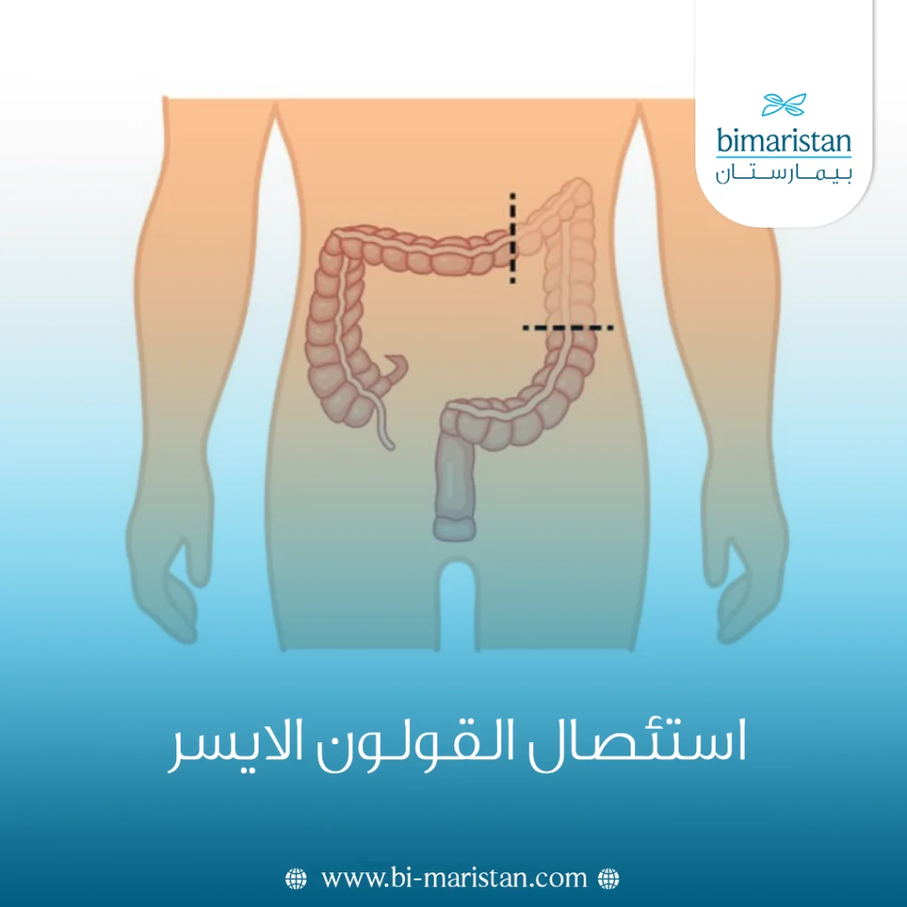 استئصال القولون الايسر