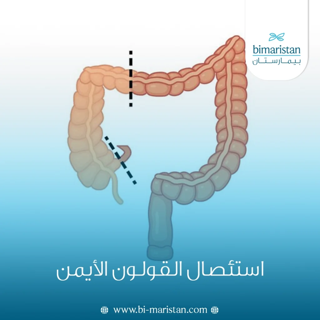 استئصال القولون الأيمن