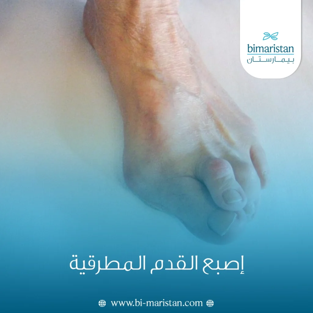 إصبع القدم المطرقية