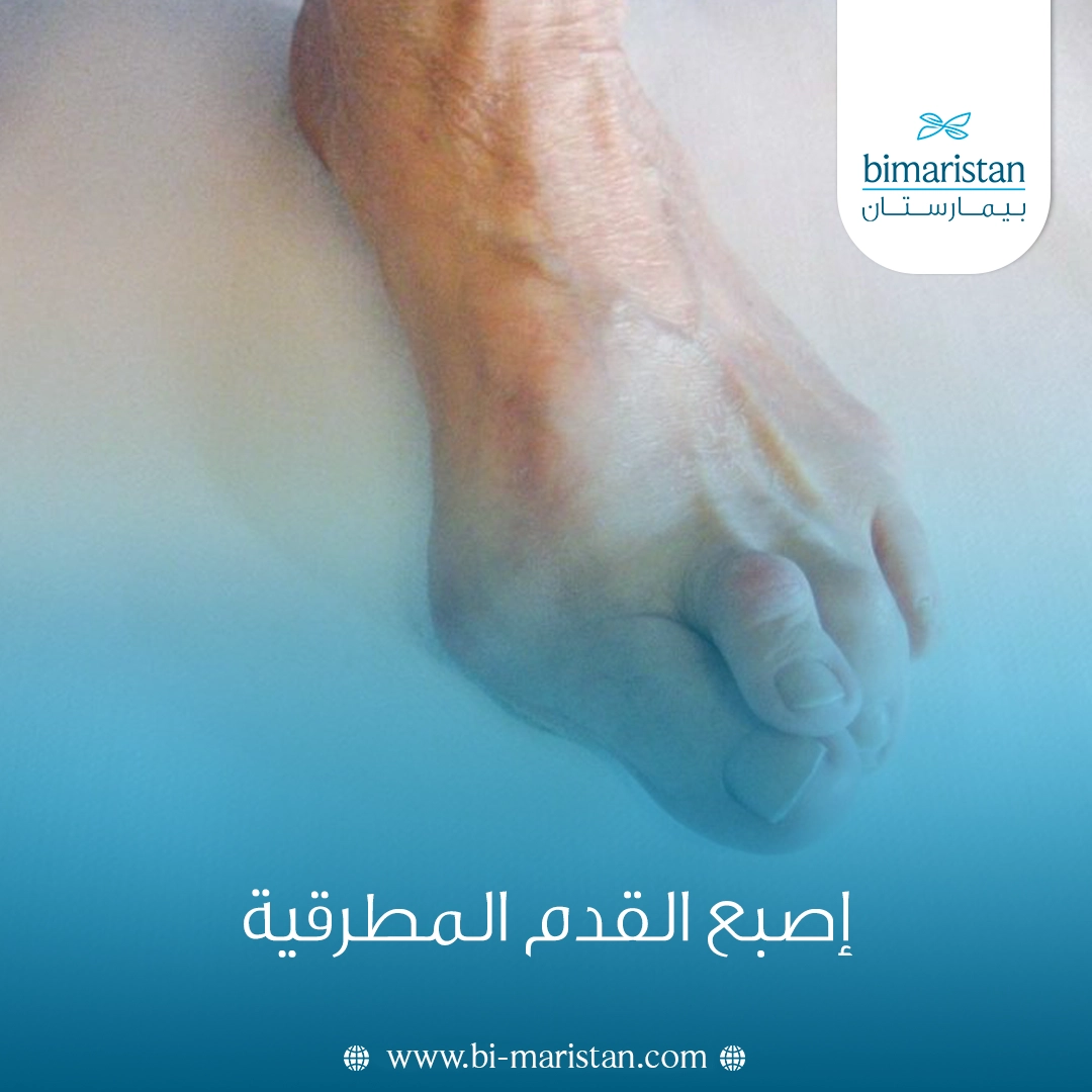 إصبع القدم المطرقية