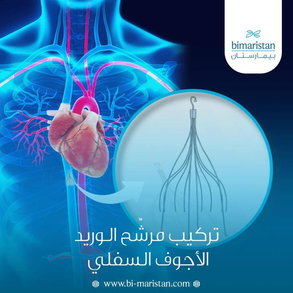 تركيب مرشّح الوريد الأجوف السفلي