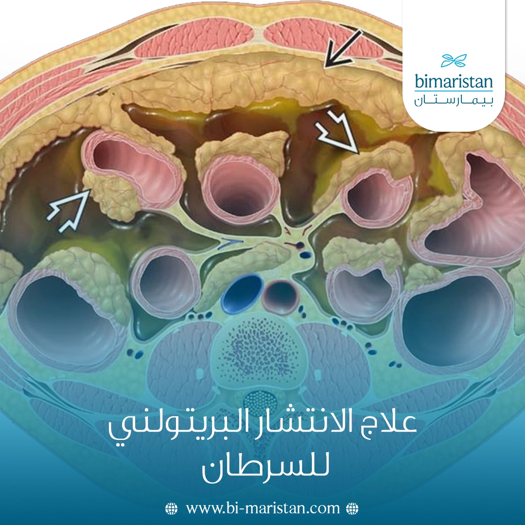 علاج الانتشار البريتولني للسرطان
