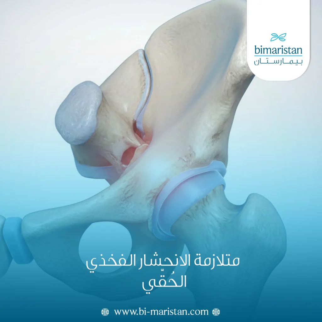متلازمة الانحشار الفخذي الحُقّي (Fai): الأسباب والأعراض والعلاج 3 متلازمة الانحشار الفخذي الحُقّي