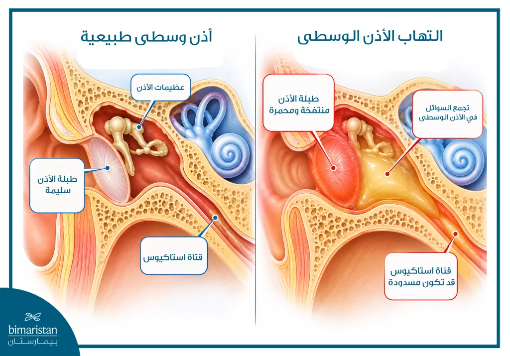 التهاب الاذن الوسطى عند الأطفال 2 صورة توضح الفرق بين الأذن الوسطى الطبيعية والتهاب الأذن الوسطى.