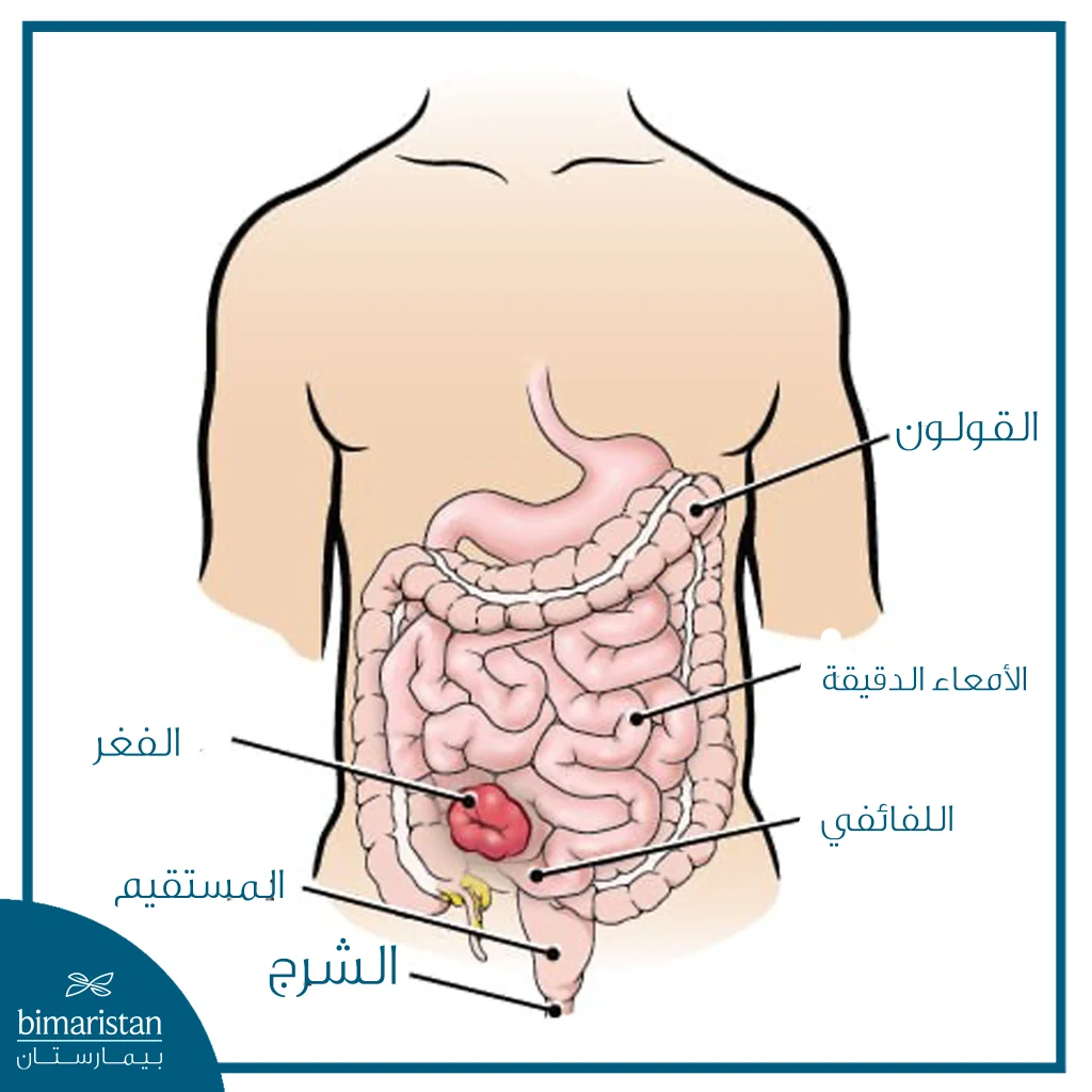 رسم تشريحي يوضح موضع الفغر على جدار البطن وعلاقته بالقولون والأمعاء الدقيقة والمستقيم والشرج.