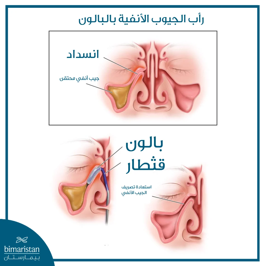 رسم توضيحي يبين الجيب قبل وبعد إجراء رأب الجيوب الأنفية بالبالون وتصريف المفرزات.