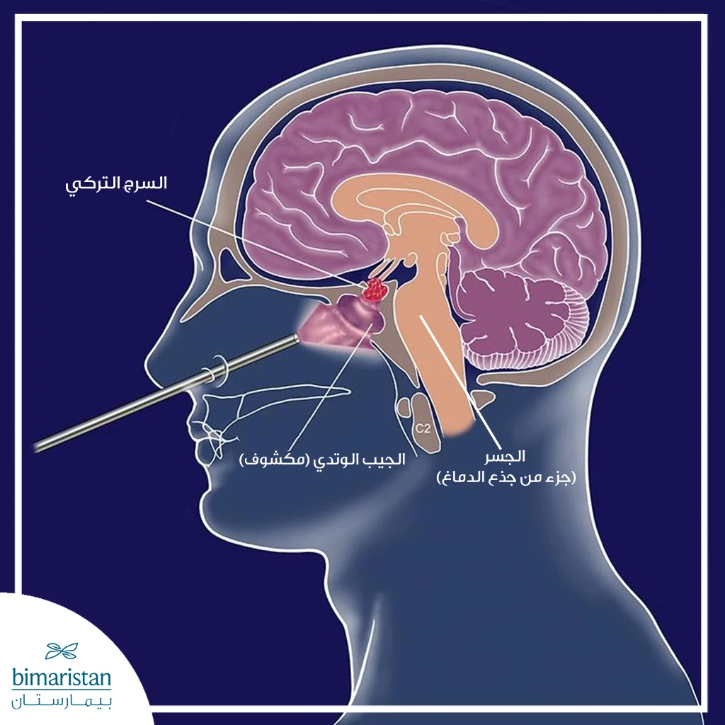 رسم توضيحي يبيّن الوصول الجراحي عبر الأنف والجيب الوتدي إلى الغدة النخامية ضمن السرج التركي.