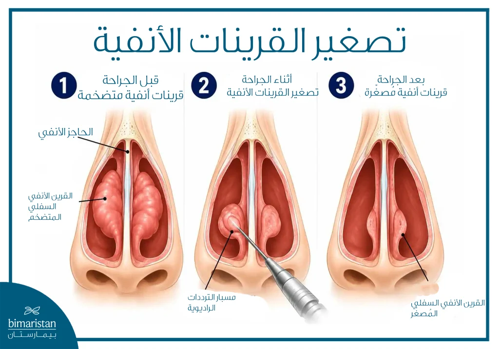 رسم توضيحي يوضح تصغير القرينات الأنفية السفلية بتقنية التردد الحراري.