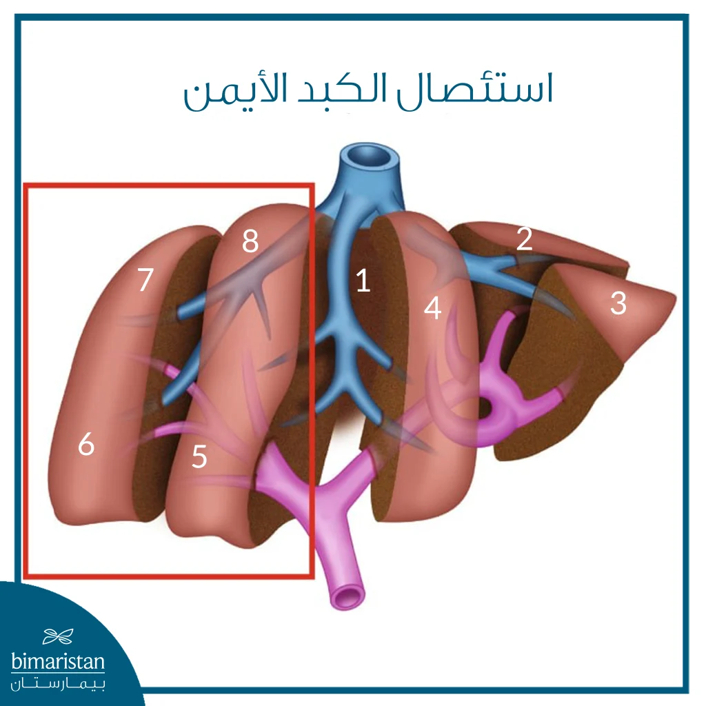 رسم طبي يوضح استئصال الكبد الأيمن مع تحديد القطاعات الكبدية المشمولة بالاستئصال.
