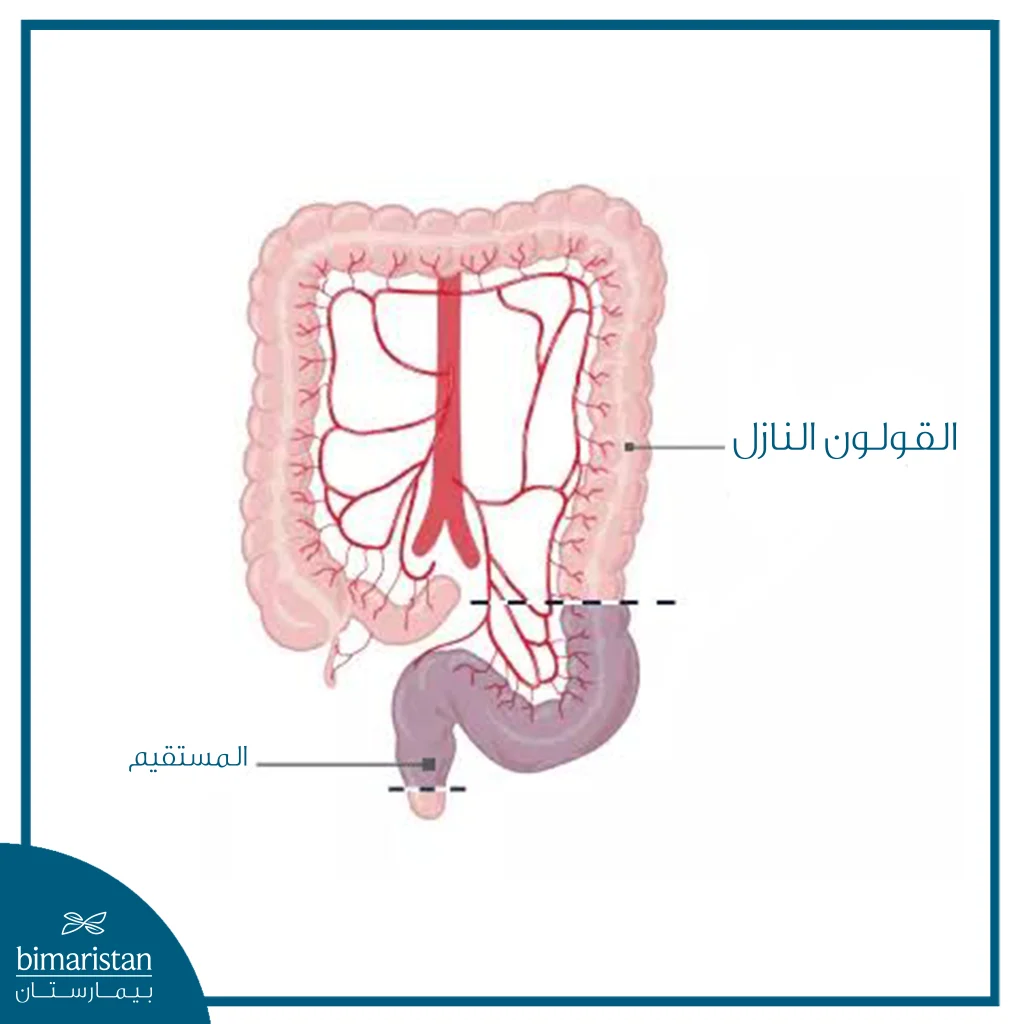 رسم طبي يوضح الجزء السفلي من القولون والمستقيم مع تحديد منطقة الاستئصال المستخدمة في جراحة الاستئصال الأمامي المنخفض للمستقيم.