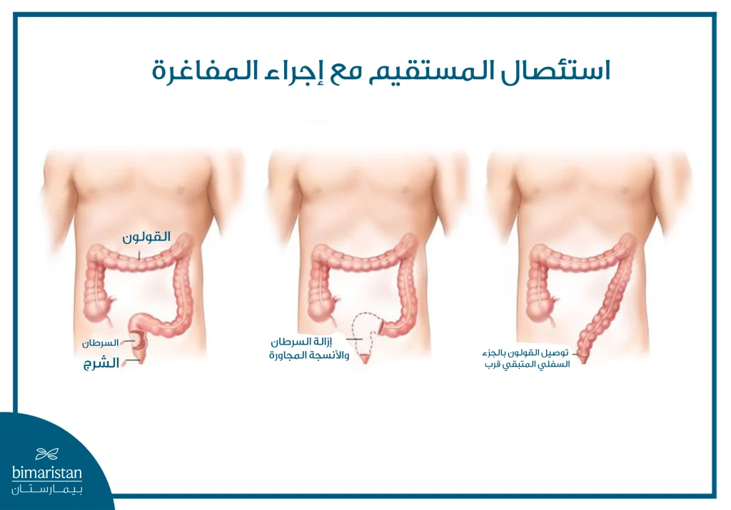 رسم طبي يوضح مراحل الاستئصال الأمامي المنخفض للمستقيم، بدءاً من إزالة الجزء المصاب بالسرطان وصولاً إلى إعادة توصيل القولون.
