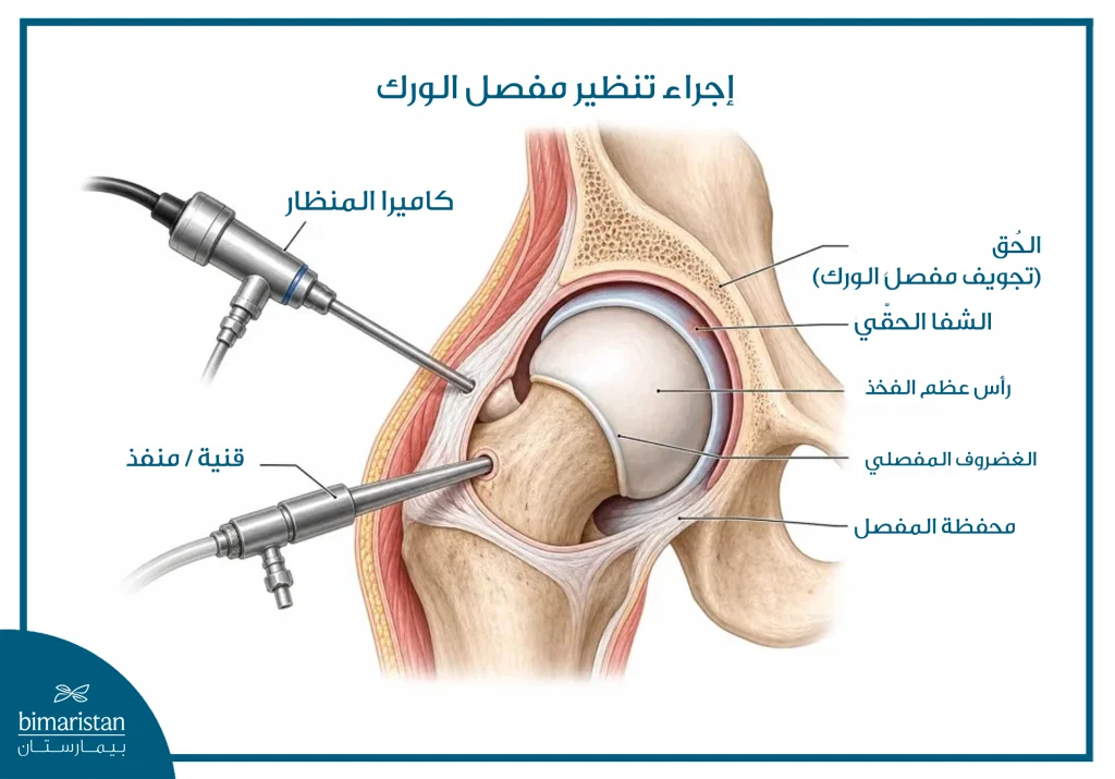 صورة توضح إجراء تنظير مفصل الورك المستخدم لعلاج متلازمة الانحشار الفخذي الحُقّي