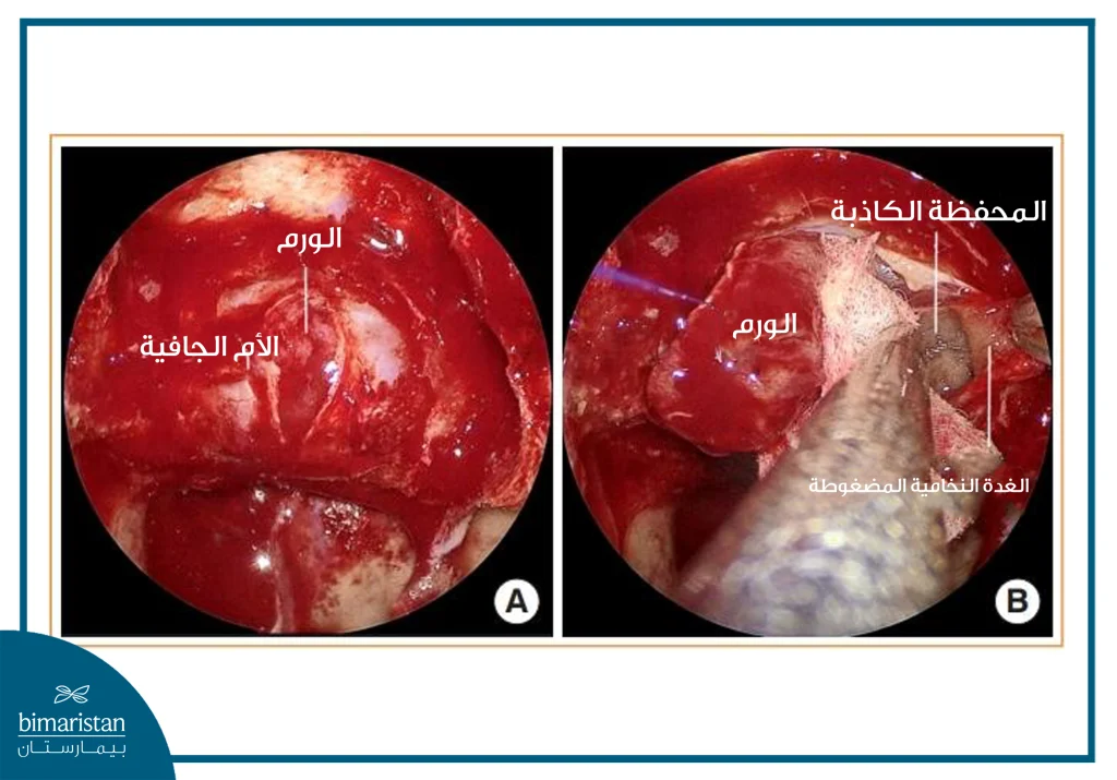 صور تنظيرية أثناء الجراحة التنظيرية عبر الأنف لاستئصال ورم نخامي.