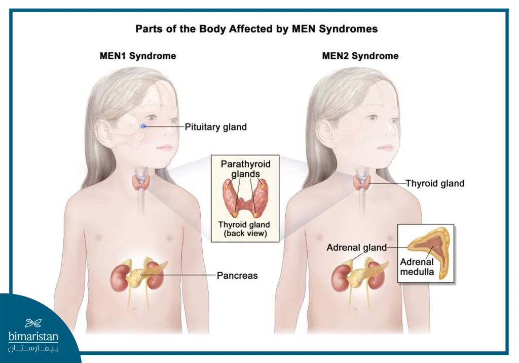 An Image Showing The Glands Affected In Each Of The Two Types Of Multiple Endocrine Neoplasia (Men) Syndrome