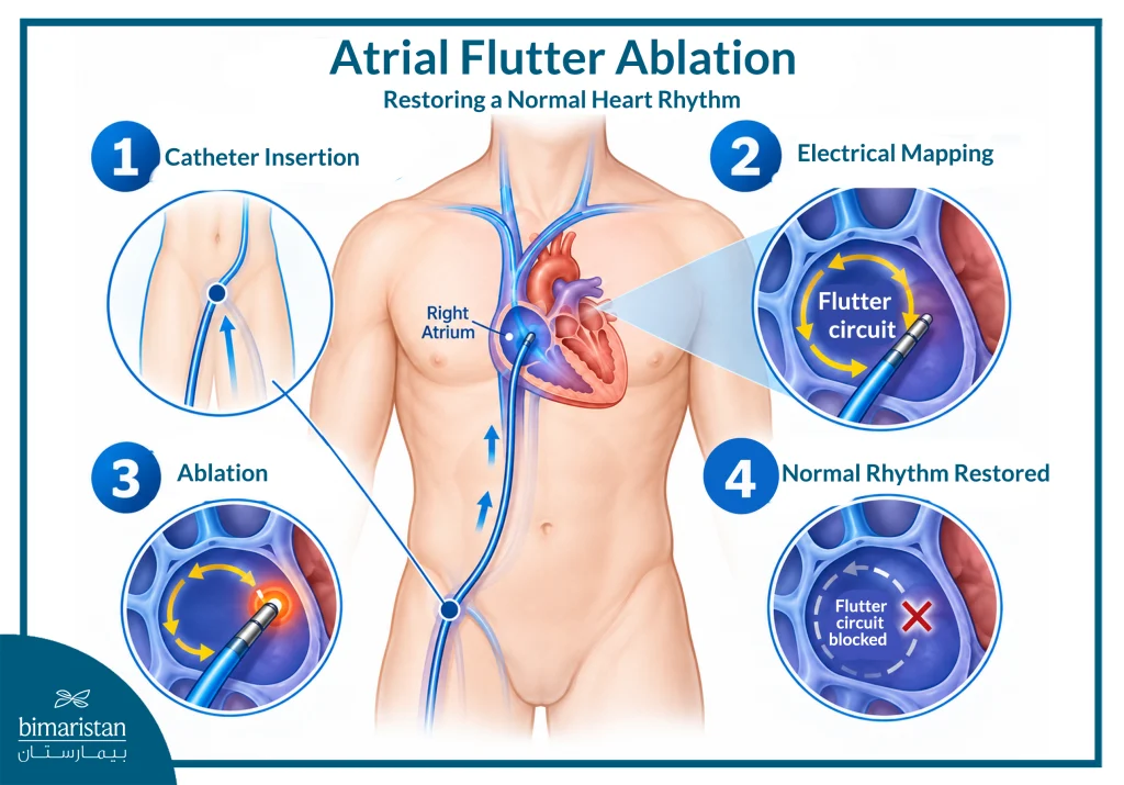 Medical Illustration Showing Atrial Flutter Ablation Inside The Heart