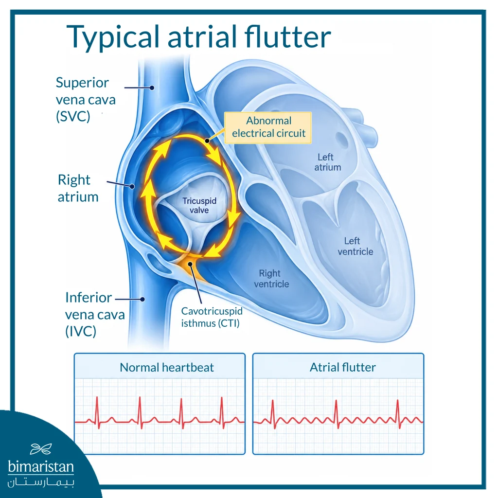 Medical Illustration Showing Typical Atrial Flutter And The Electrical Circuit Within The Right Atrium