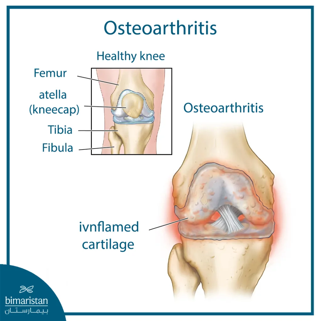The Difference Between A Healthy Knee And An Injured Knee