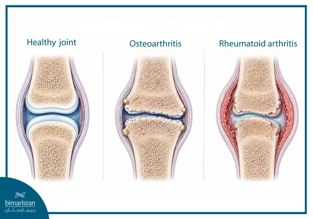 Types Of Arthritis