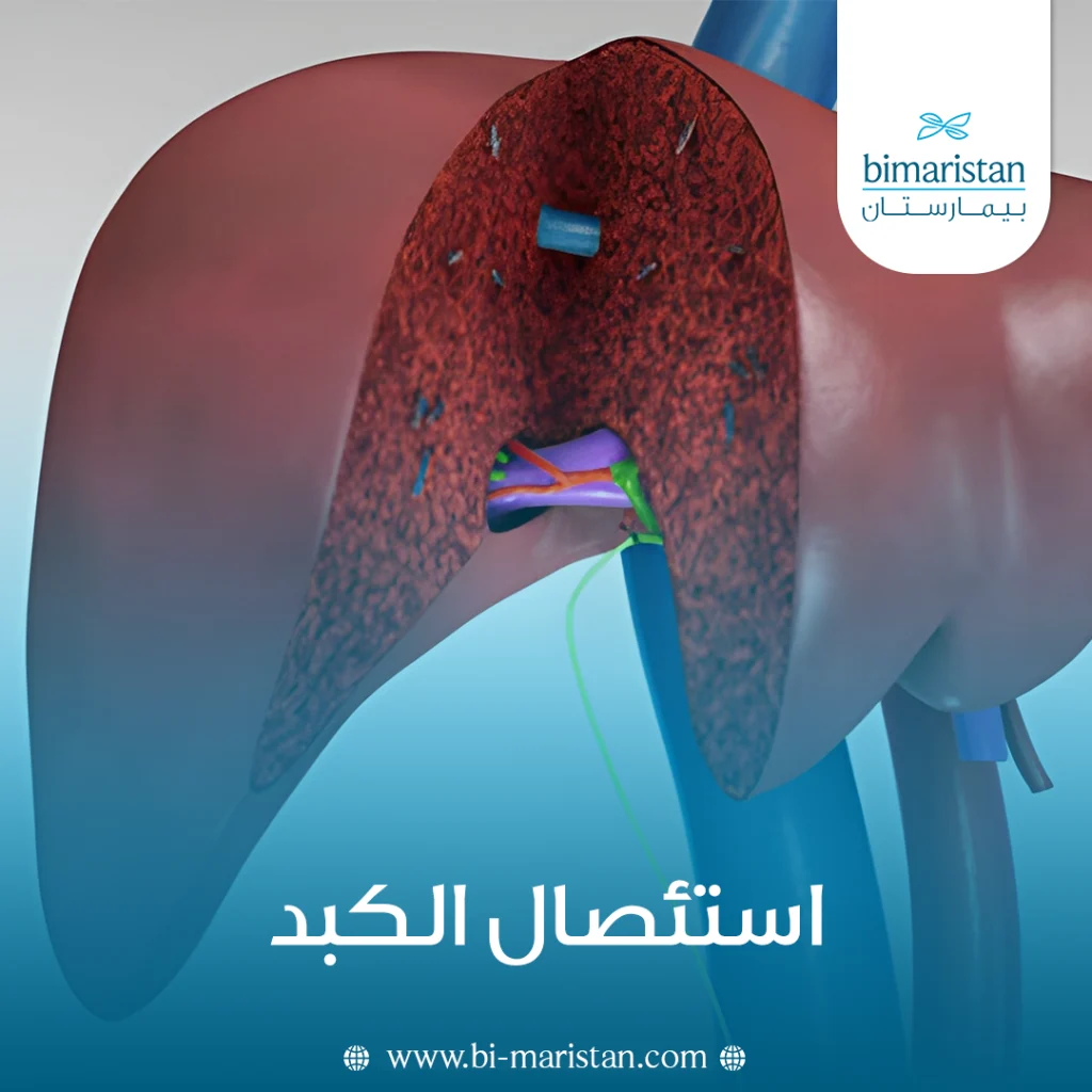 استئصال الكبد