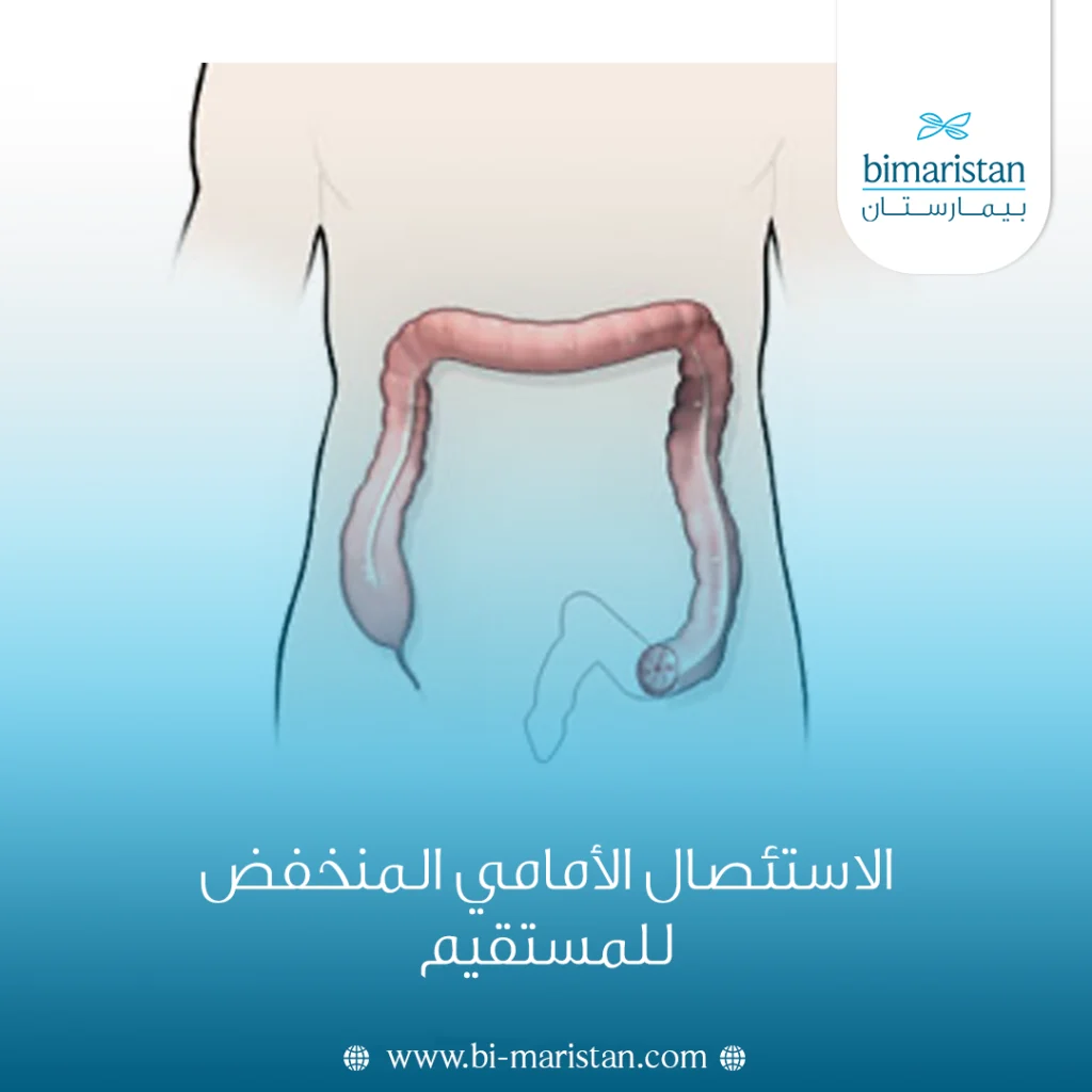 الاستئصال الأمامي المنخفض للمستقيم