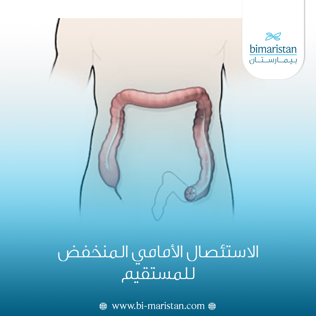 الاستئصال الأمامي المنخفض للمستقيم